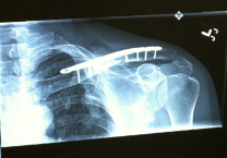 X-ray of Swenson's reconstructed clavicle
