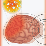 An illustration showing microbubbles in the skull collapsing and damaging brain cells.