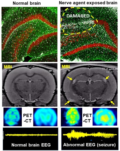 A sideb-by-side comparison showing scans of a normal brain with scans of a brain exposed to a nerve agent. The nerve-agent exposed brain shows signs of abnormalities.